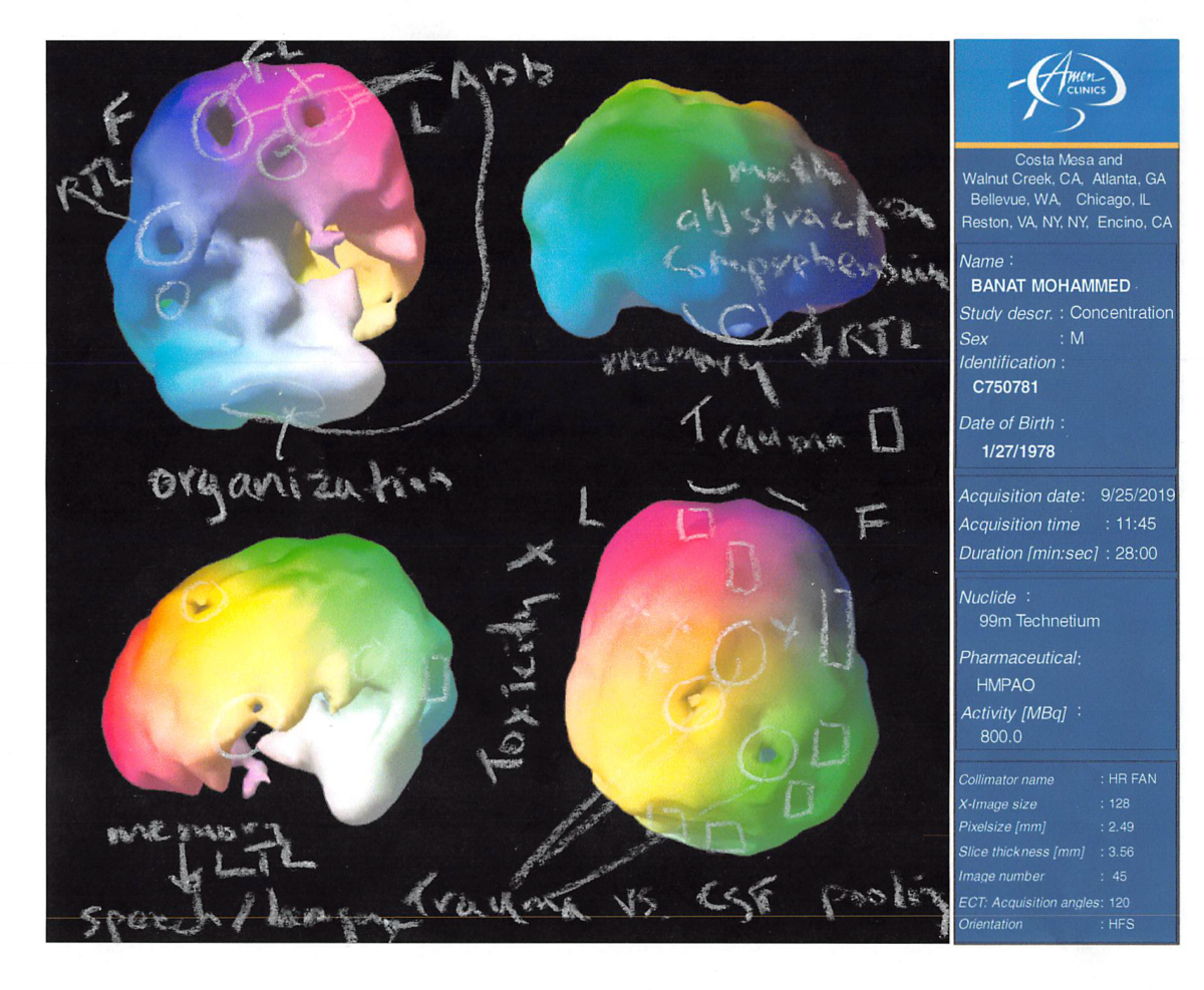 SPECT Scan – Brain Resection