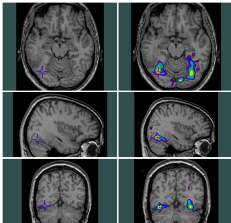 First Brain Tumor Surgery – Brain Resection