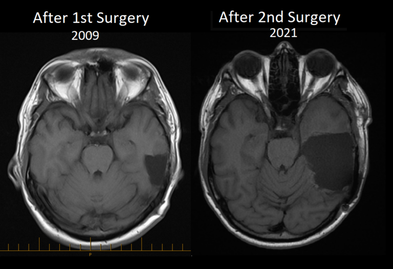 Brain Resection | The Surgery in Spain - Brain Resection